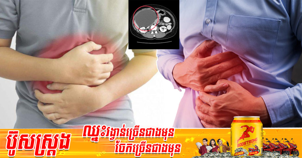 បុរសម្នាក់ចេះមានអាការៈហើមពោះ ណែនពោះ ជាង១ឆ្នាំលេបថ្នាំអីក៏មិនបាន ក៏សម្រេចទៅពេទ្យពិនិត្យទើបដឹងការពិត