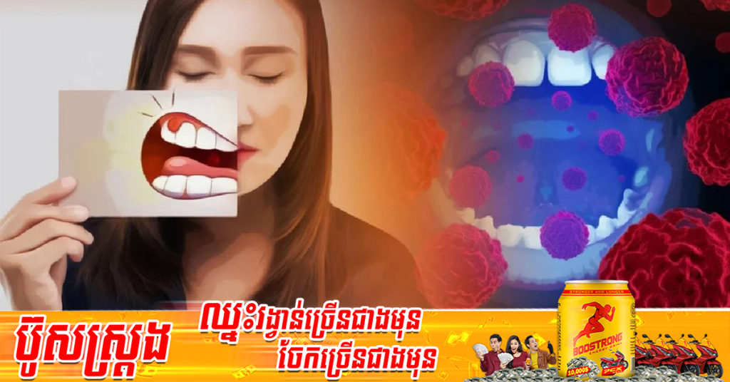 វេជ្ជបណ្ឌិតថៃ បង្ហាញពីសញ្ញាណតឿនអោយដឹងអំពីជំងឺមហារីកមាត់ ដែលយើងគួរតែដឹង