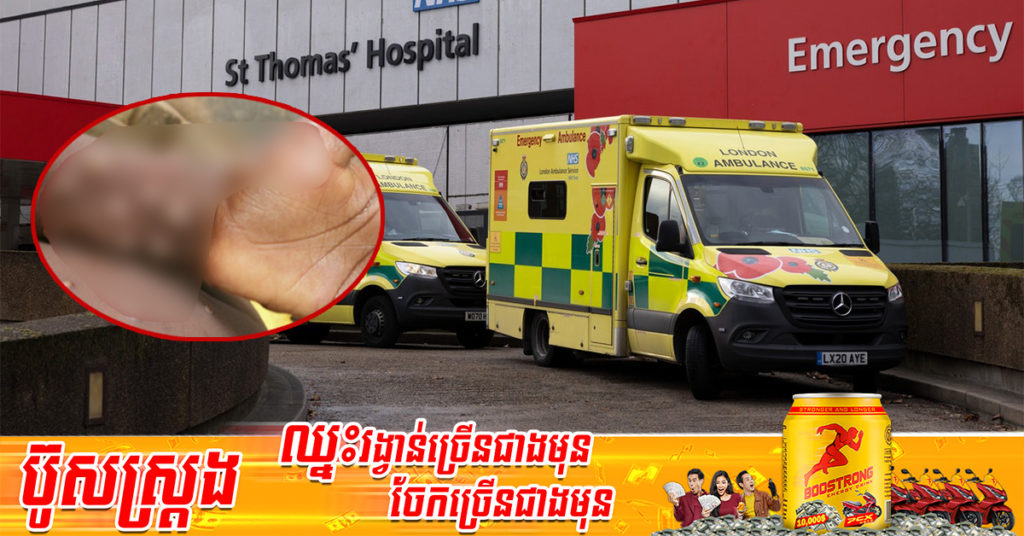 អង់គ្លេសបានរាយការណ៍ពីករណីដ៏កម្រនៃជំងឺអុតស្វាយ Monkeypox ដែលកើតមានលើអ្នកដំណើរម្នាក់មកពីប្រទេសនីហ្សេរីយ៉ា