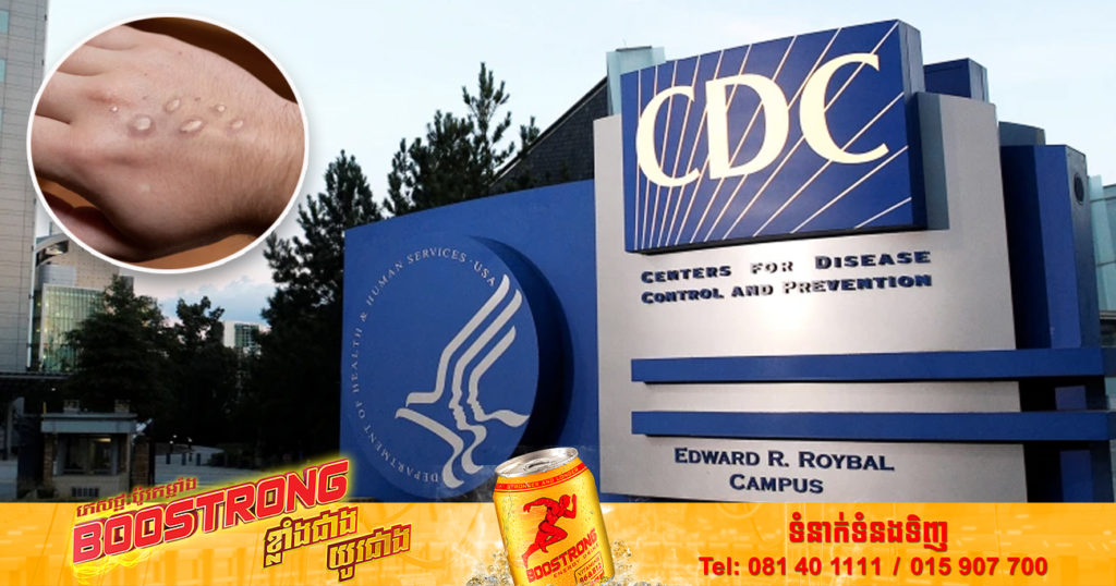 ចំនួន​ករណី​ជំងឺ​អុត​ស្វា Monkeypox ​ដែល​បាន​បញ្ជាក់​នៅសហរដ្ឋអាមេរិកបាន​កើន​ដល់​ ១០,០០០ ករណី