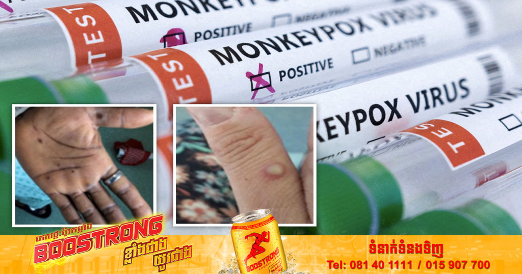 អង្គការសុខភាពពិភពលោកកំពុងសិក្សាមើលថា តើការផ្លាស់ប្តូរហ្សែនរបស់ជំងឺអុតស្វា នៅពីក្រោយការរីករាលដាលនាពេលបច្ចុប្បន្ន ឬយ៉ាងណា