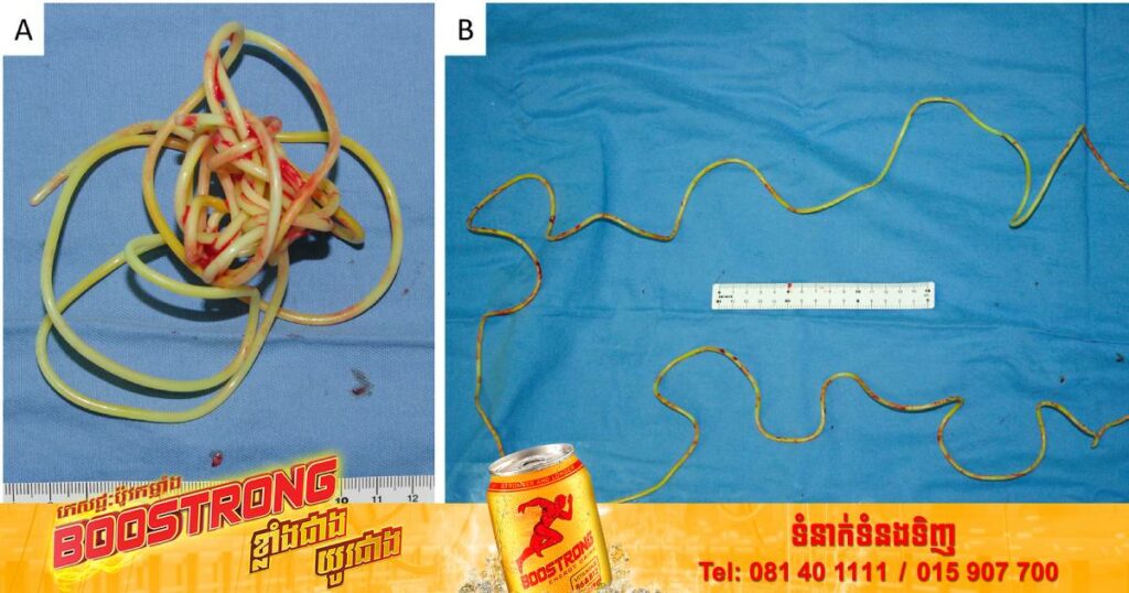 វេជ្ជបណ្ឌិតរកឃើញខ្សែដ៏វែងនៅក្នុងប្លោកនោមបុរសជប៉ុនម្នាក់ ក្រោយជនរងគ្រោះបានធ្វើសកម្មភាពដ៏ចម្លែកមួយនេះ