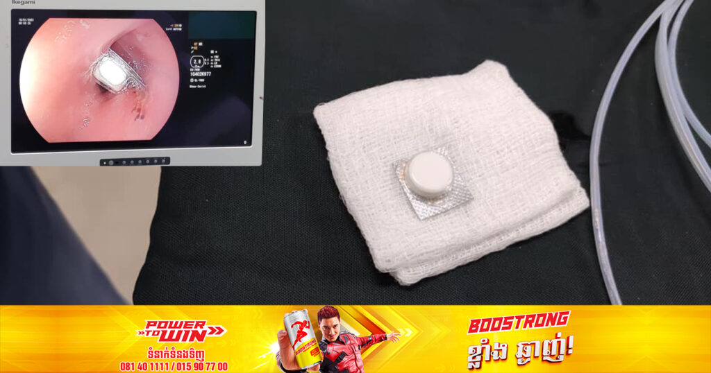 បុរសម្នាក់ខ្វះការប្រុងប្រយ័ត្នលេបថ្នាំទាំងសំបកចូលក្នុងបំពង់អាហារ ត្រូវបានក្រុមគ្រូពេទ្យជំនាញមន្ទីរពេទ្យមិត្តភាពខ្មែរ-សូវៀតសង្គ្រោះយកចេញភ្លាមៗ