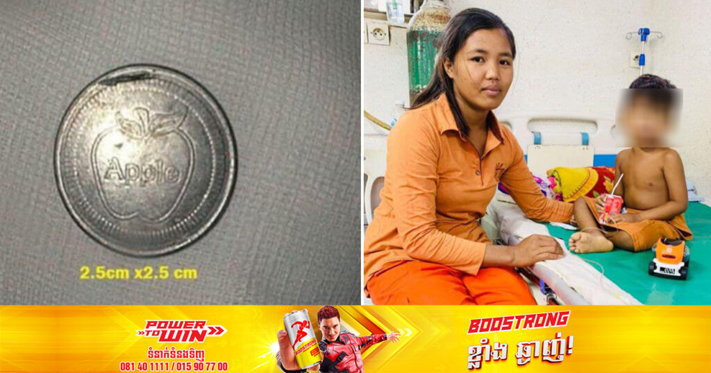 អាយុថ្លៃណាស់! កុមារាម្នាក់ អាយុ៣ឆ្នាំ បានលេបកាក់ចូលក្នុងបំពង់អាហារអស់រយៈពេល៣ខែ ត្រូវបានក្រុមគ្រូពេទ្យសង្រ្គោះឱ្យរួចផុតគ្រោះថ្នាក់