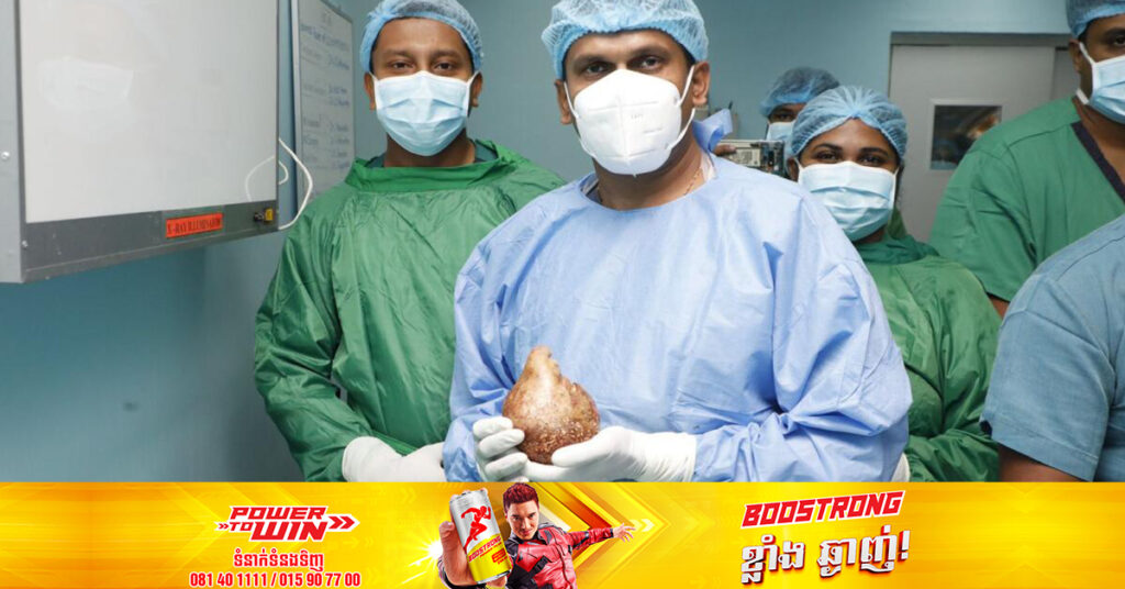 គ្រួស ក្នុងតម្រងនោមធំបំផុតនៅលើពិភពលោកត្រូវបានរកឃើញនៅក្នុងខ្លួនអ្នកជំងឺម្នាក់នៅប្រទេសស្រីលង្កា