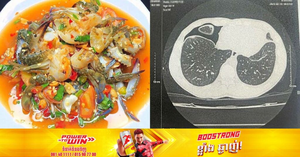 បុរសវៀតណាមម្នាក់ស្ទើរតែអស់ជីវិត ក្រោយញ៉ាំក្តាមសមុទ្រស្រស់ដែលមានមេរោគ