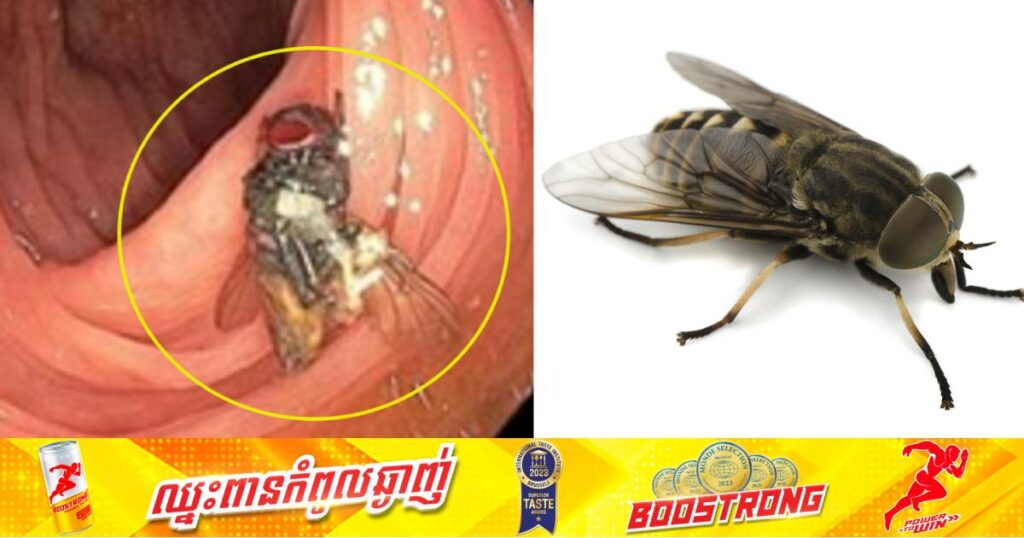 សត្វរុយមួយក្បាលត្រូវបានគេរកឃើញនៅជាប់ក្នុងពោះវៀនអ្នកជំងឺម្នាក់យ៉ាងកម្របំផុត