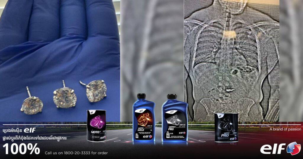 ក្រុមគ្រូពេទ្យបានយកក្រវិលពេជ្រតម្លៃជិត ៨០ម៉ឺនដុល្លារពីក្នុងខ្លួនចោរម្នាក់ ដែលបានបន្លំលេបចូលទៅក្នុងពោះពេលដើរទស្សនាការដាក់តាំងគ្រឿងអលង្ការនៅអាមេរិក